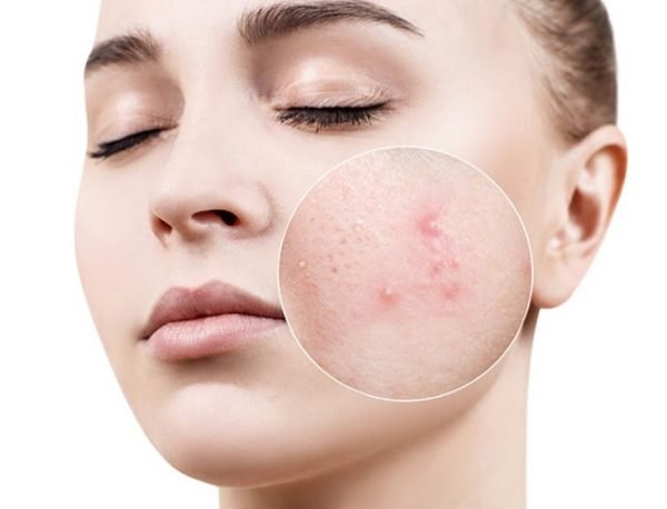 Bí mật cách chăm sóc da mặt bị mụn hiệu quả 2021